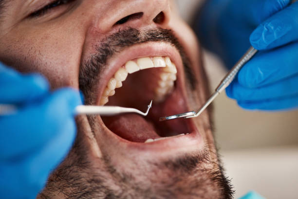 Best Wisdom Tooth Removal  in North Tunica, MS